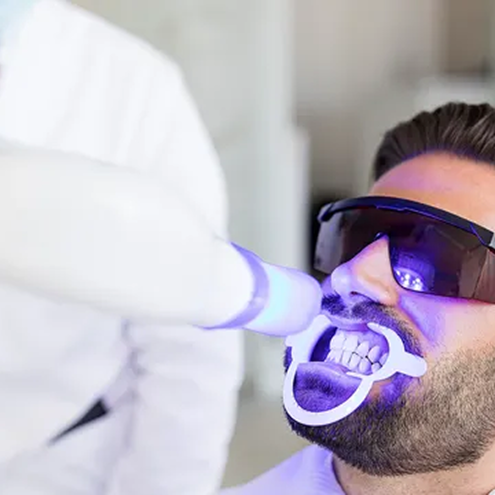 قص وتوريد لثة بالليزر